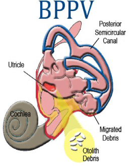 BPPV